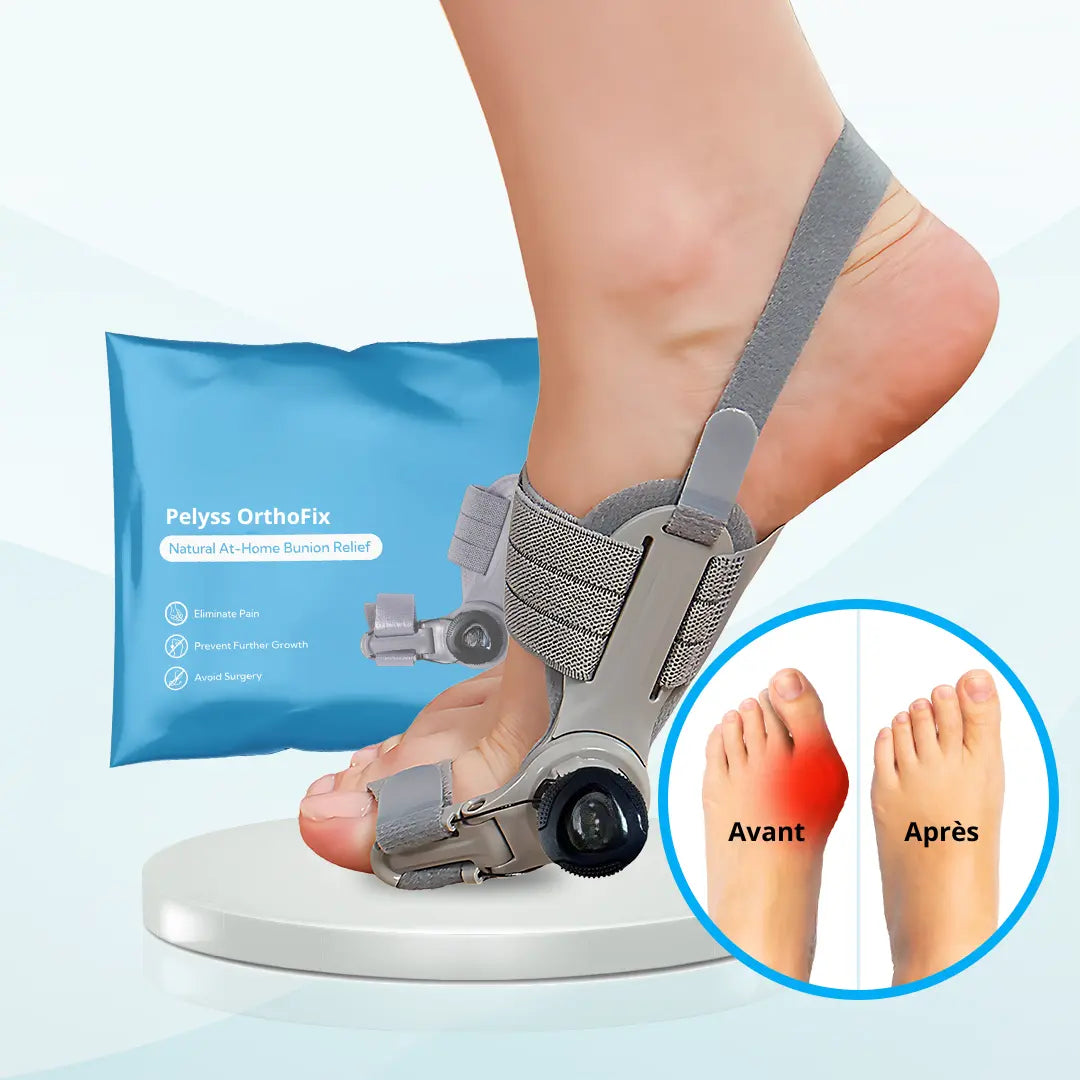 Pelyss™ OrthoFix — Correcteur d'Hallux Valgus Articulé